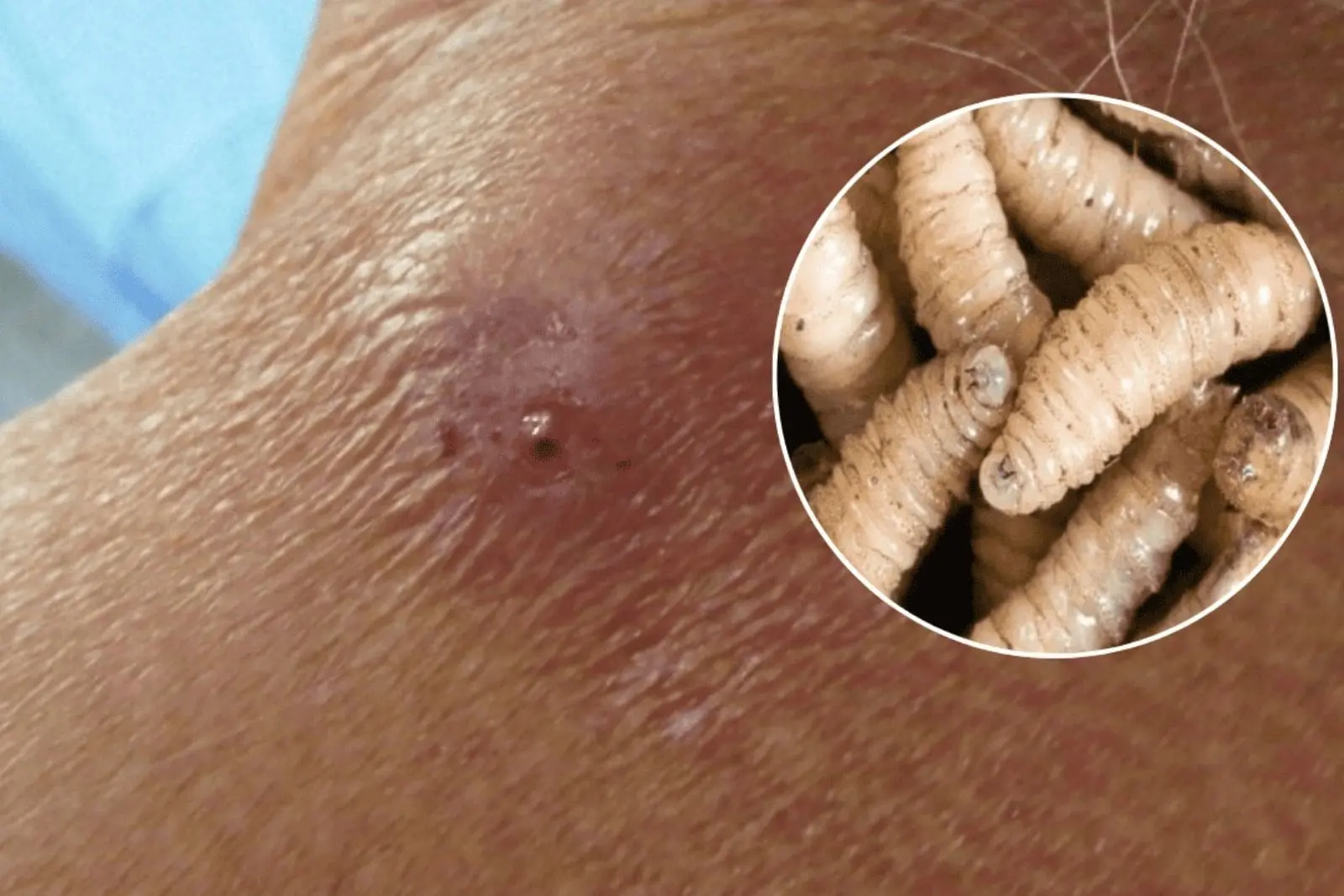 Se registra primer caso de miasis por gusano barrenador en Pachuca